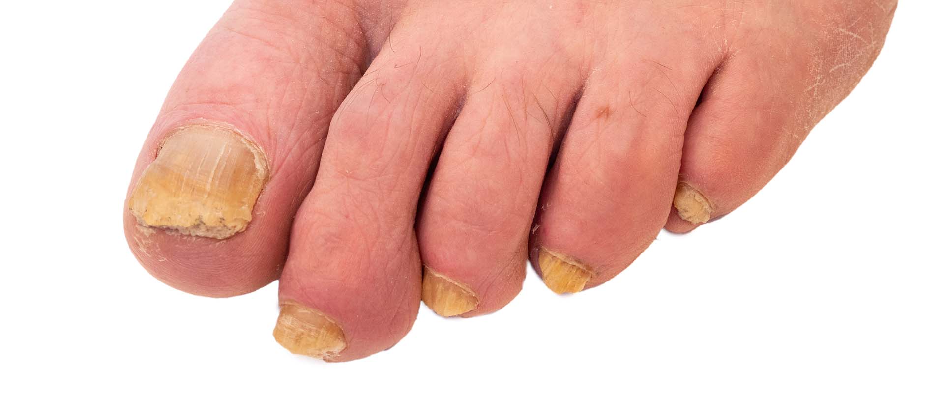 Fungal Nails Treatment Melbourne | Your Foot Clinic Podiatry
